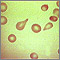 Glóbulos rojos sanguíneos en forma de lágrima