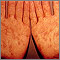 Sífilis - secundaria en las palmas de las manos