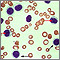 Leucemia de células pilosas - vista microscópica