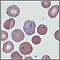 Malaria, vista microscópica de parásitos celulares