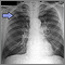 Adenocarcinoma - placa de rayos x de tórax