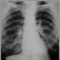 Pulmones de un trabajador del carbon -  radiografía de tórax