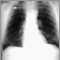 Nódulo pulmonary - vista frontal en placa de rayos x de tórax