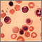 Eritroblastosis fetal - foto micrografía