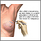 Biopsia abierta del seno