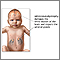 Adrenoleucodistrofia neonatal