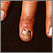 Infección de uñas - candida