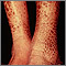 Ictiosis, adquirida - piernas