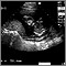 Ultrasonido de un feto normal - cara