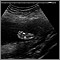 Ultrasonido de un feto normal - pie
