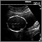 Ultrasonido de un feto normal - medidas de la cabeza