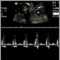 Latidos cardíacos en un ultrasonido de la comunicación interventricular