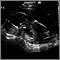 Ultrasonido de un feto normal - vista de perfil