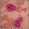 Mononucleosis - microfotografía de la célula