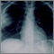 Aspergilosis - radiografía de tórax