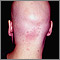 Alopecia total - vista posterior de la cabeza