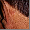 Cáncer de piel - carcinoma de célula basal detrás de la oreja