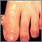 Verruga con un cuerno cutáneo en el dedo del pie
