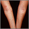 Dermatitis - atópica de los brazos