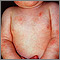 Dermatitis - atópica en un bebé