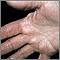Hiperlinearidad de la dermatitis atópica de la palma de la mano
