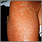 Exfoliación subsiguiente a la eritrodermia