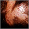 Foliculitis - descalvante en el cuero cabelludo