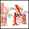 Isquemia e infarto de las arterias mesentéricas