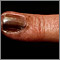 Cáncer de piel o melanoma en la uña del dedo de la mano