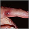 Lesión de Janeway en un dedo