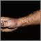 Esporotricosis en la mano y el brazo