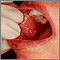 Liquen plano en la mucosa oral