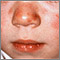 Lupus - discoide en el rostro de un niño