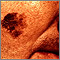 Cáncer de piel, primer plano del melanoma léntigo maligno