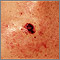 Cáncer de piel - primer plano del melanoma de nivel IV