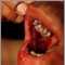 Lesiones orales por pénfigo vulgar