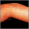 Herpes zoster (culebrilla) en el brazo