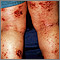 Dermatitis - atópica de las piernas