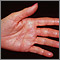 Herpes zoster (culebrilla) en la mano