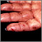 Dermatitis herpetiforme en la mano