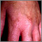Dermatitis de fotocontacto de la mano