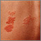 Herpes zoster (culebrilla) en la espalda