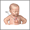 Defecto congénito del corazón - serie - Anatoma del corazn del beb