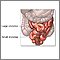 Resección de intestino delgado - serie