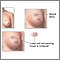 Excisión de un tumor en el seno