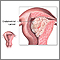 Cáncer endometrial