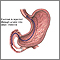Inyección de contraste en el intestino delgado
