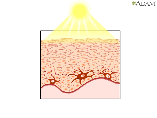 Efectos del sol en la piel - Videos de salud: MedlinePlus enciclopedia  médica